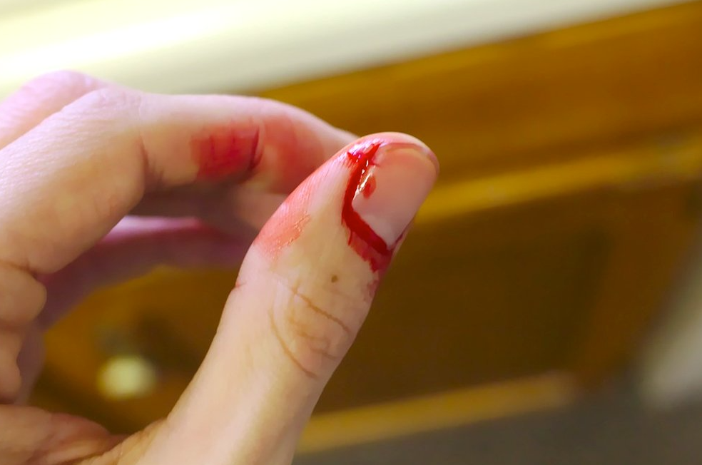 bleeding injury